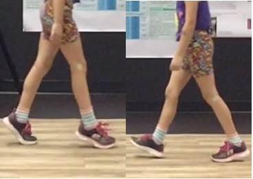 legs of child on left walking on toes, legs of child on right walking with a heel toe pattern